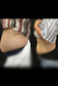 نمونه قبل و بعد استفاده از دستگاه اکسلیس برای لاغری شکم و پهلو